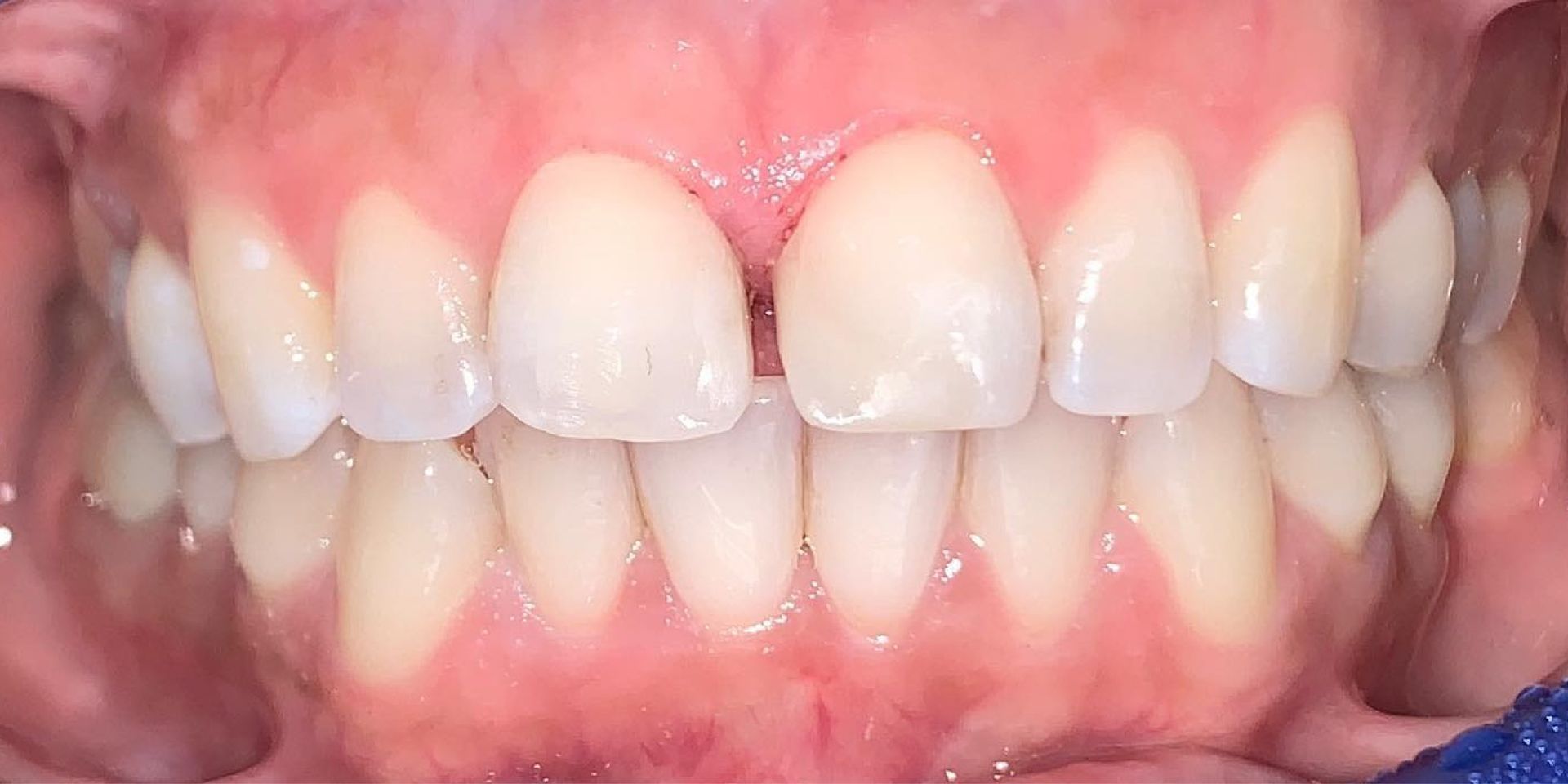 After treatment at Farzad Dental