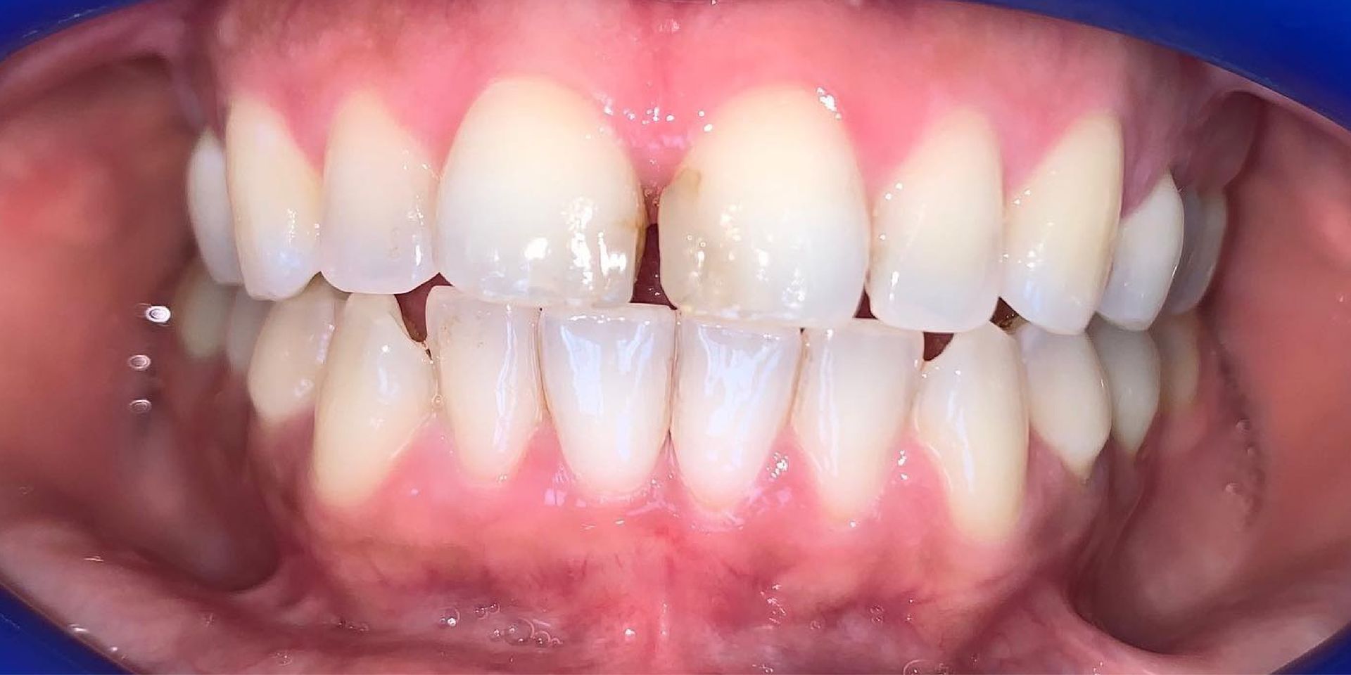 Before treatment at Farzad Dental
