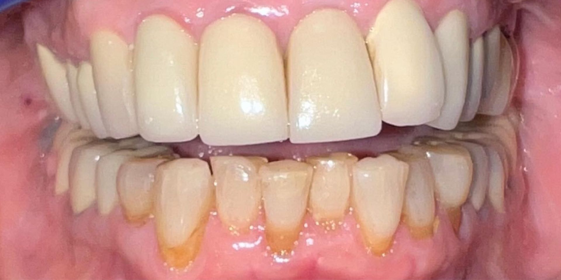 Before treatment at Farzad Dental