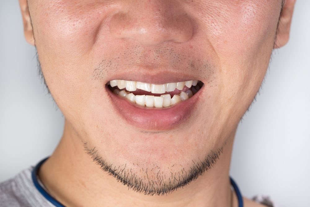 Cracked & Chipped Teeth at Farzad Dental