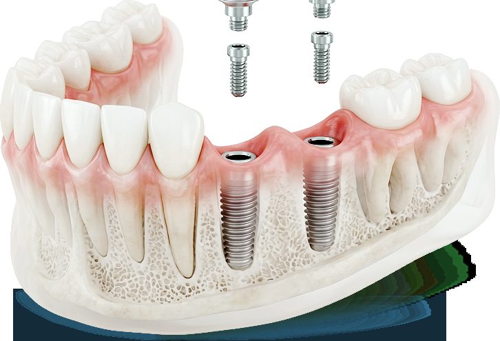 Restorative dentistry at Farzad Dental