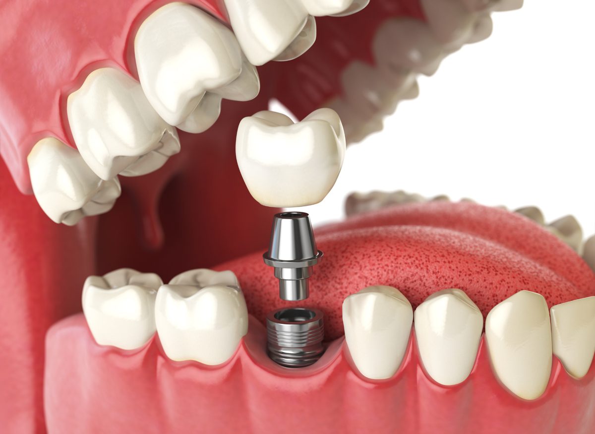 Dental Implant Maintenance at Farzad Dental