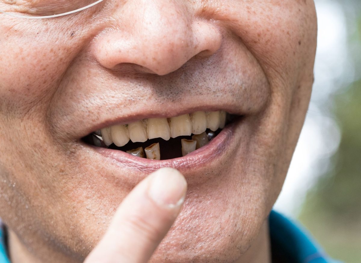 Failing, Missing or Knocked-Out Teeth at Farzad Dental