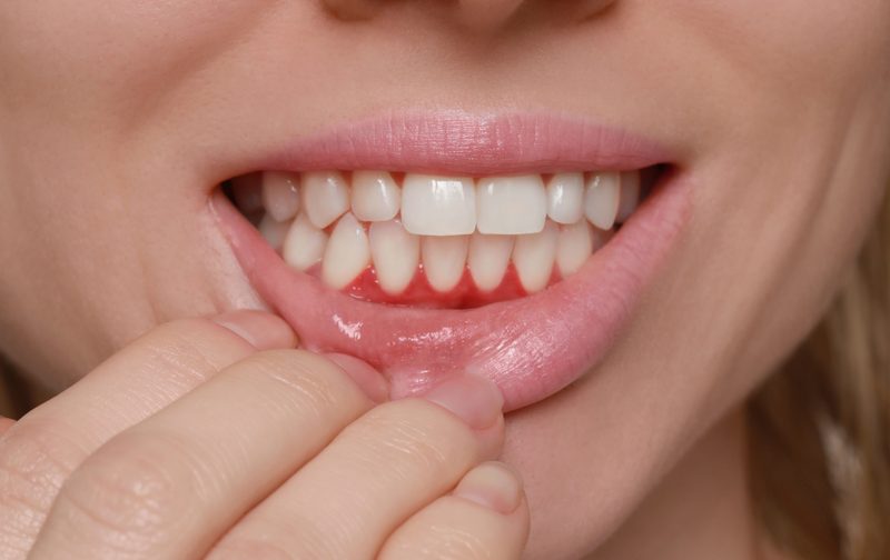 Gum Disease at Farzad Dental