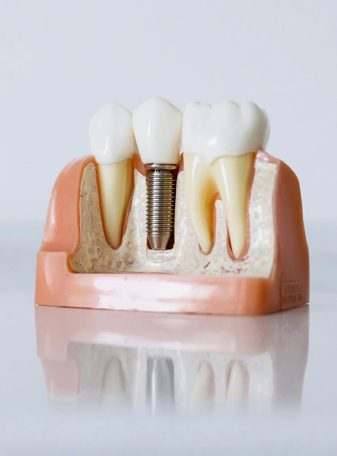Dental implant consultation at Farzad Dental