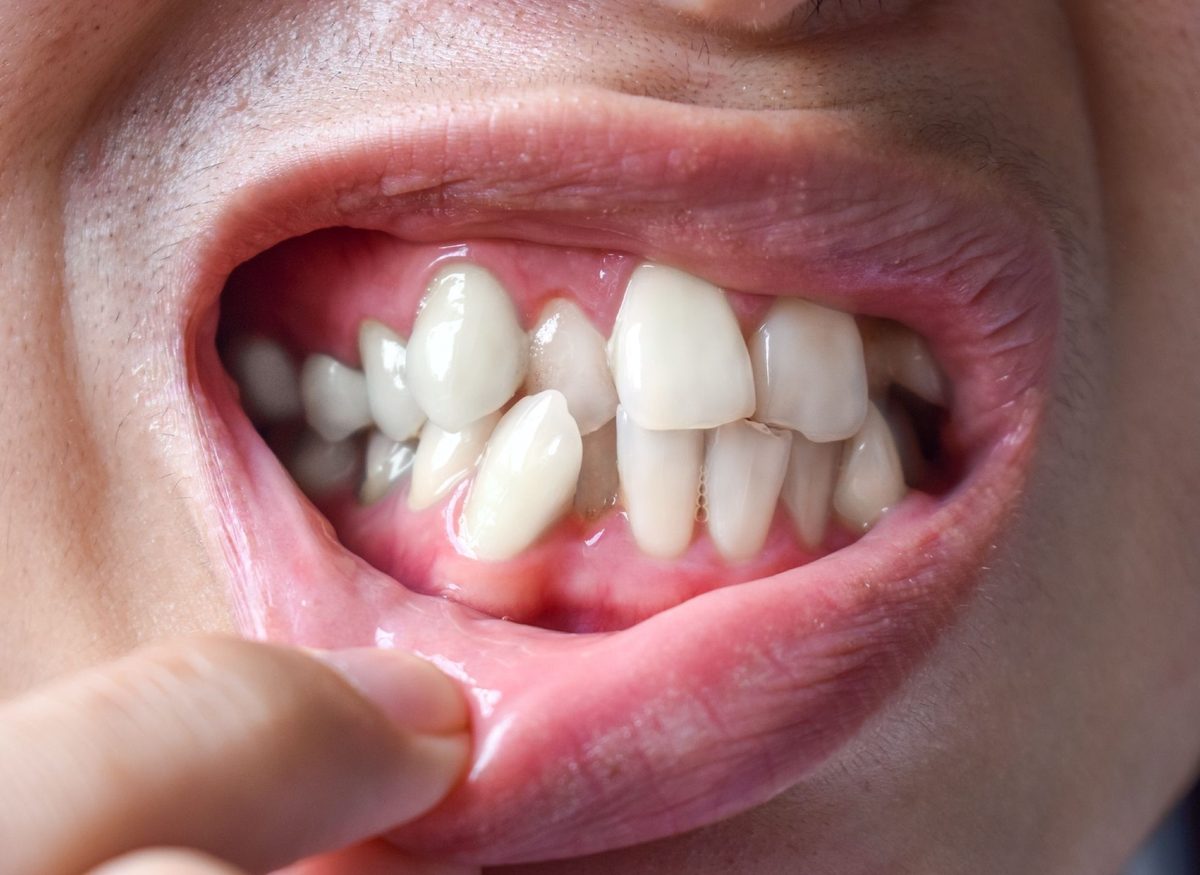 Misaligned Teeth at Farzad Dental