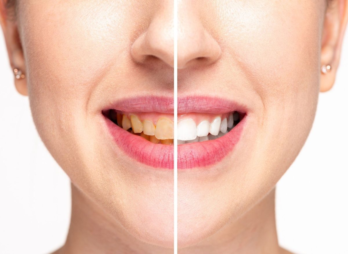 Stained & Discolored Teeth at Farzad Dental